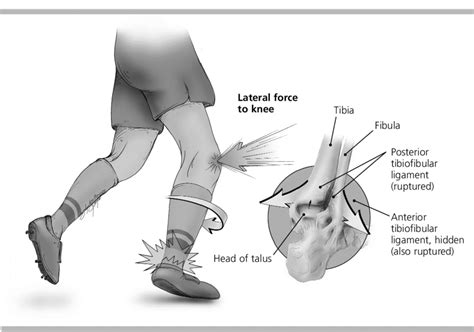 test for interosseous membrane tear|Ankle Syndesmosis Injuries: Anatomy, Biomechanics, Mechanis.